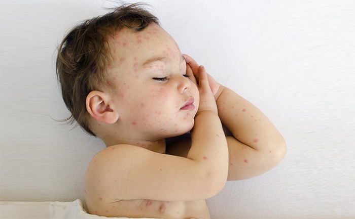 Cara Ampuh Menghilangkan Bekas Gigitan Nyamuk pada Bayi Tanpa Meninggalkan Bekas