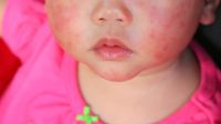 Cara Mencegah Alergi Dingin Pada Si Kecil Yang Ampuh dan Aman