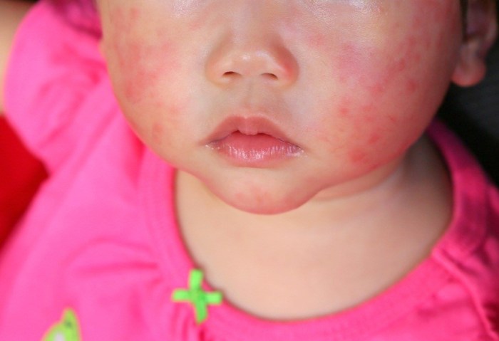 Cara Mencegah Alergi Dingin Pada Si Kecil Yang Ampuh dan Aman