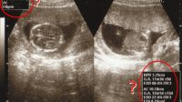 Panduan Lengkap USG Kehamilan: Persiapan, Proses, dan Hasil